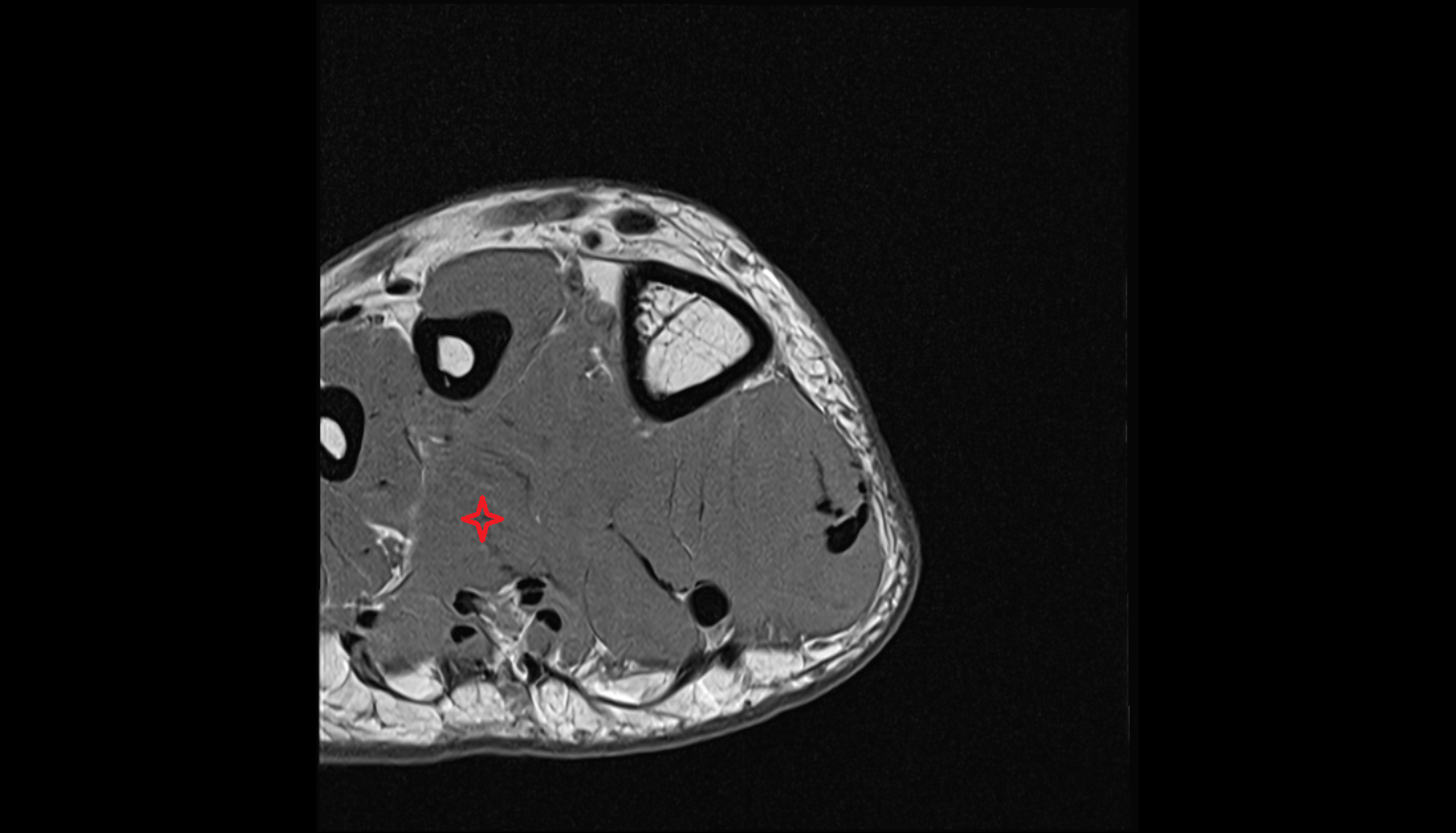 oblique head of Adductor hallucis muscle axial cross sectional anatomy 3T MRI AI enhanced radiology image-img-00000-00000_00002