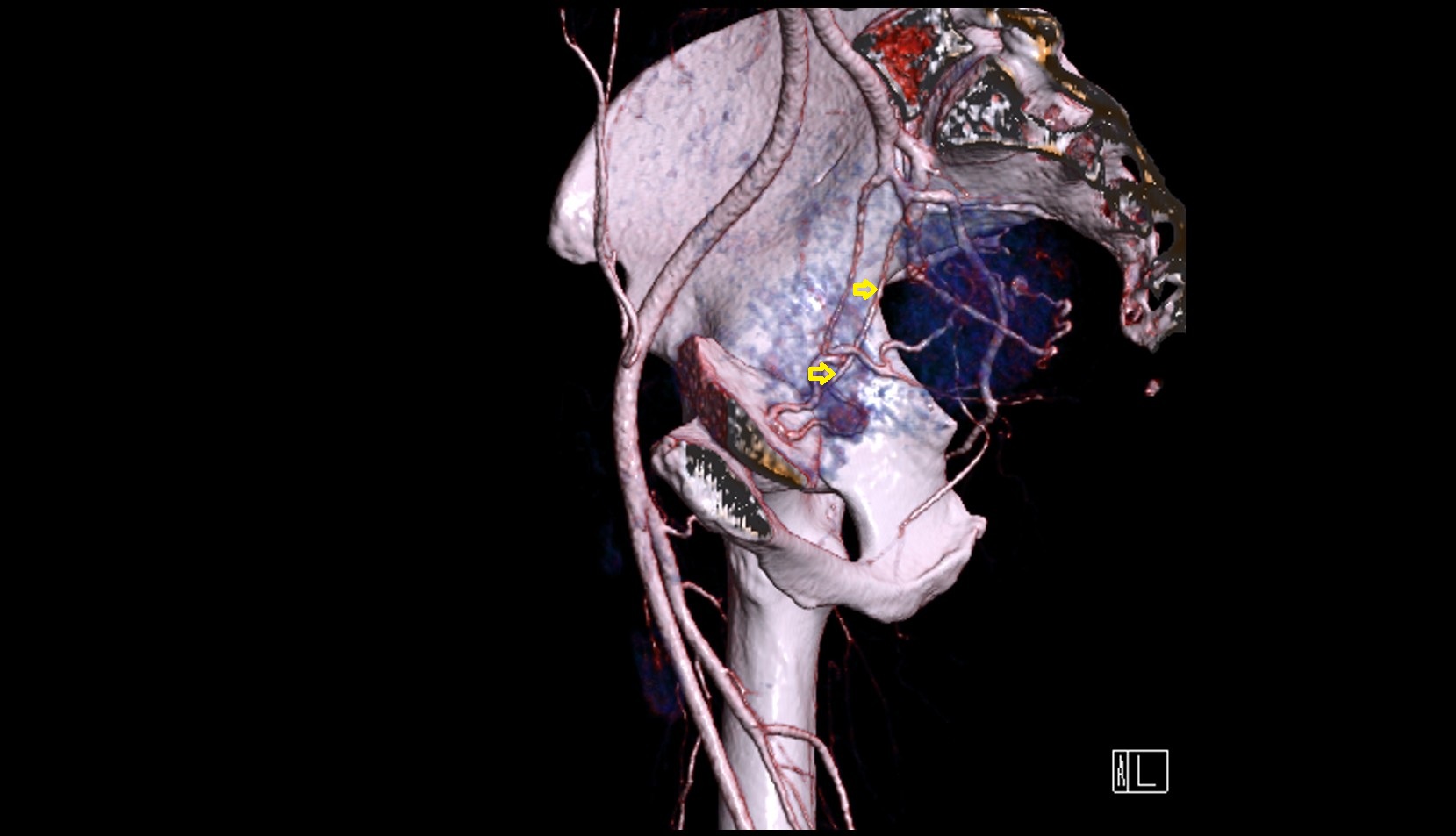 obturator artery  CT 3D VRT anatomy image