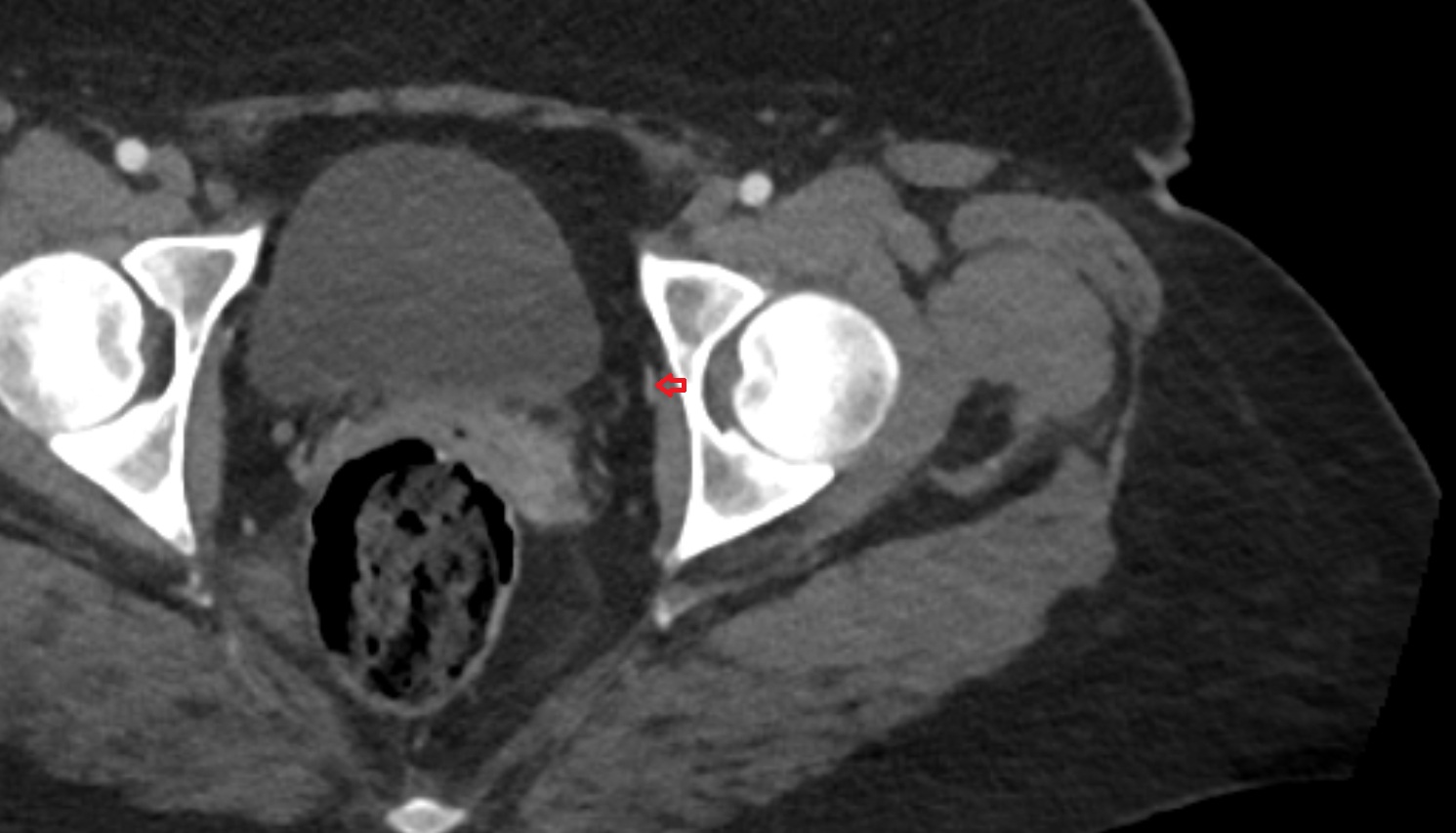 obturator artery  CT axial image  MRI  axial  anatomy  image-img-00000-00000