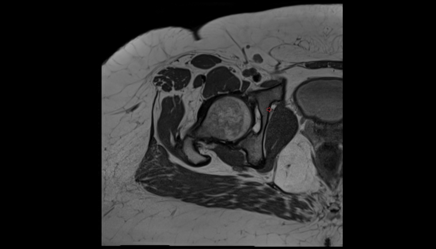 obturator artery  MRI axial image  MRI  axial  anatomy  image-img-00000-00000_00002
