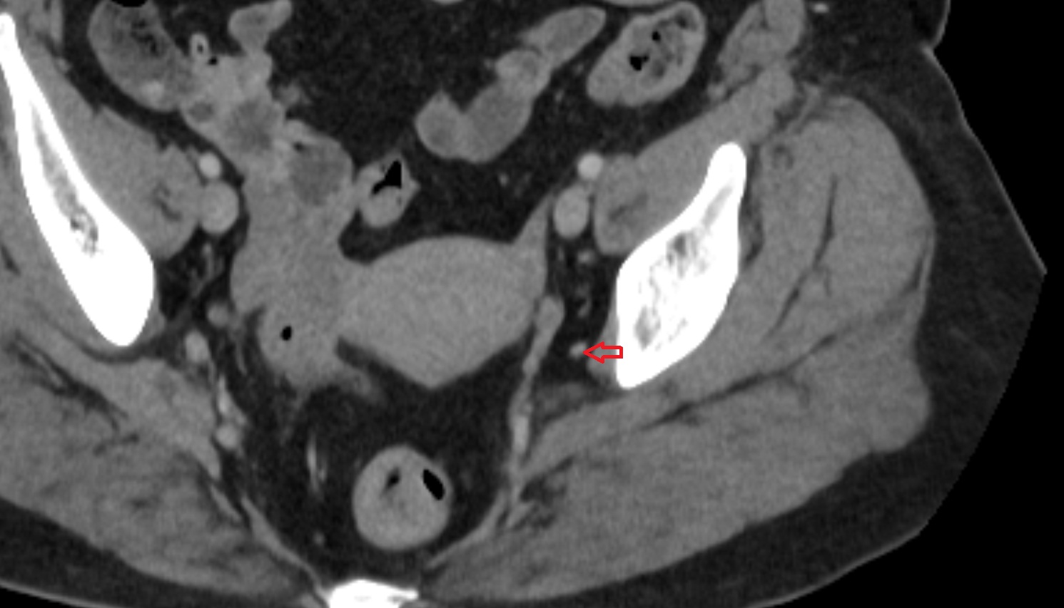 obturator vein  CT axial  anatomy  image-img-00000-00000