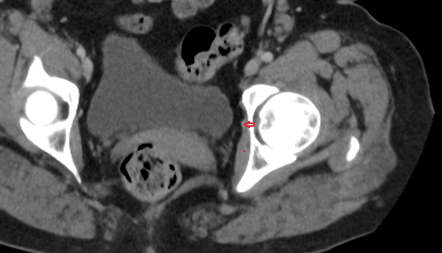 obturator vein  CT axial  anatomy  image-img-00000-00000_00001