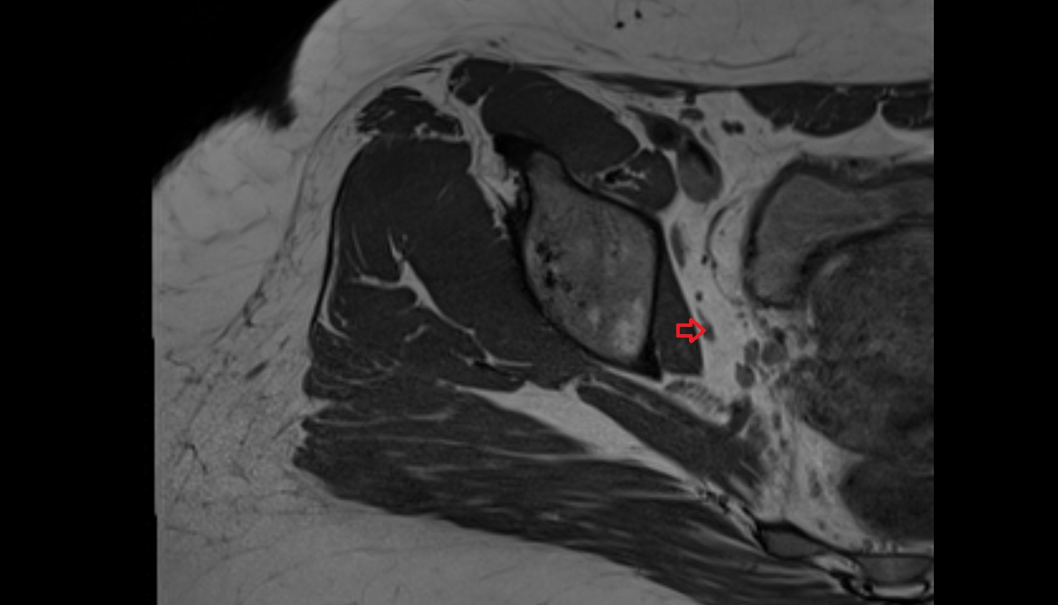 obturator vein  mri axial  anatomy  image-img-00000-00000