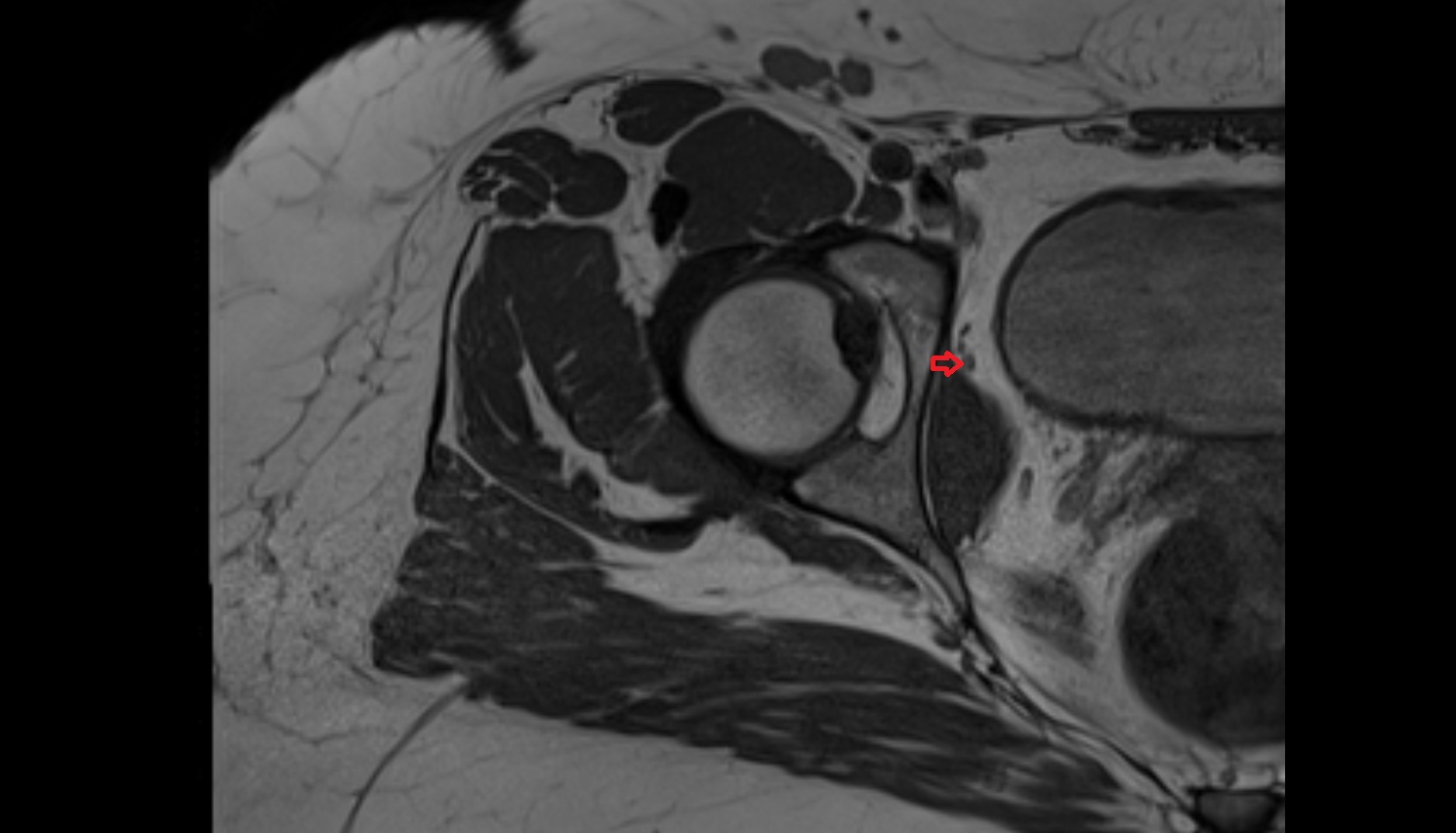 obturator vein  mri axial  anatomy  image-img-00000-00000_00001