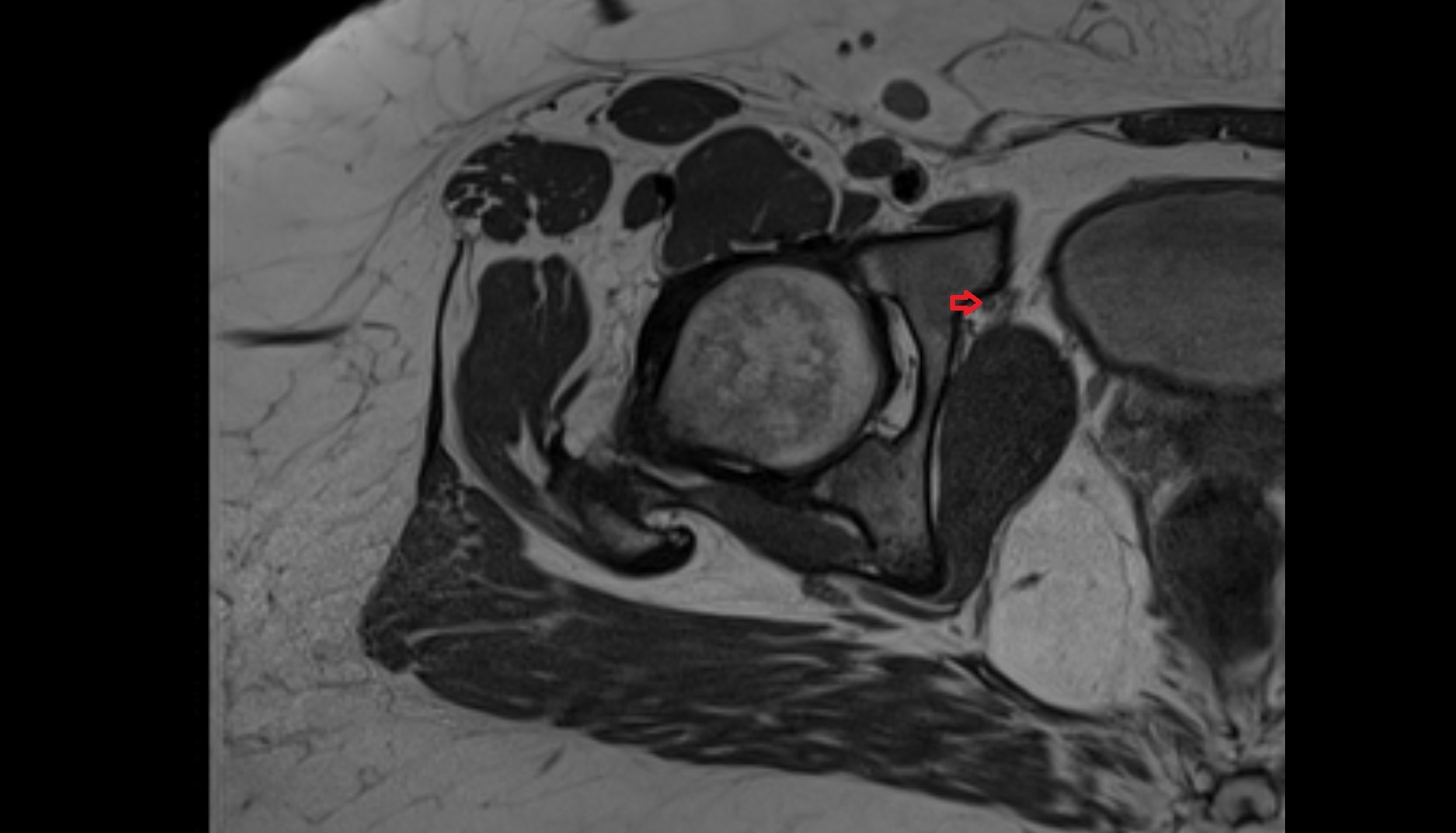 obturator vein  mri axial  anatomy  image-img-00000-00000_00002