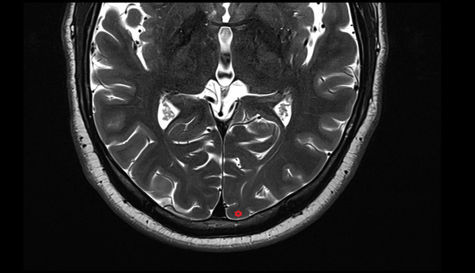 occipital pole mri 3t axial image