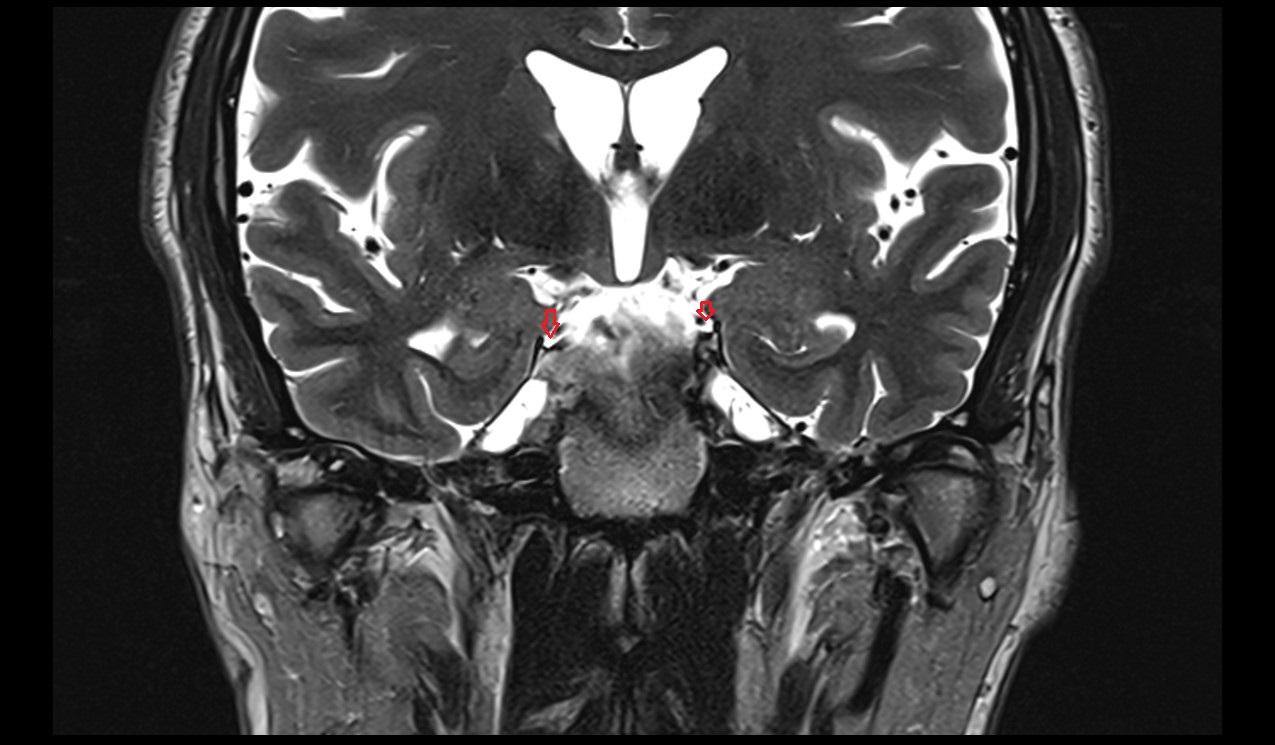 oculomotor cistern mri 3t coronal image
