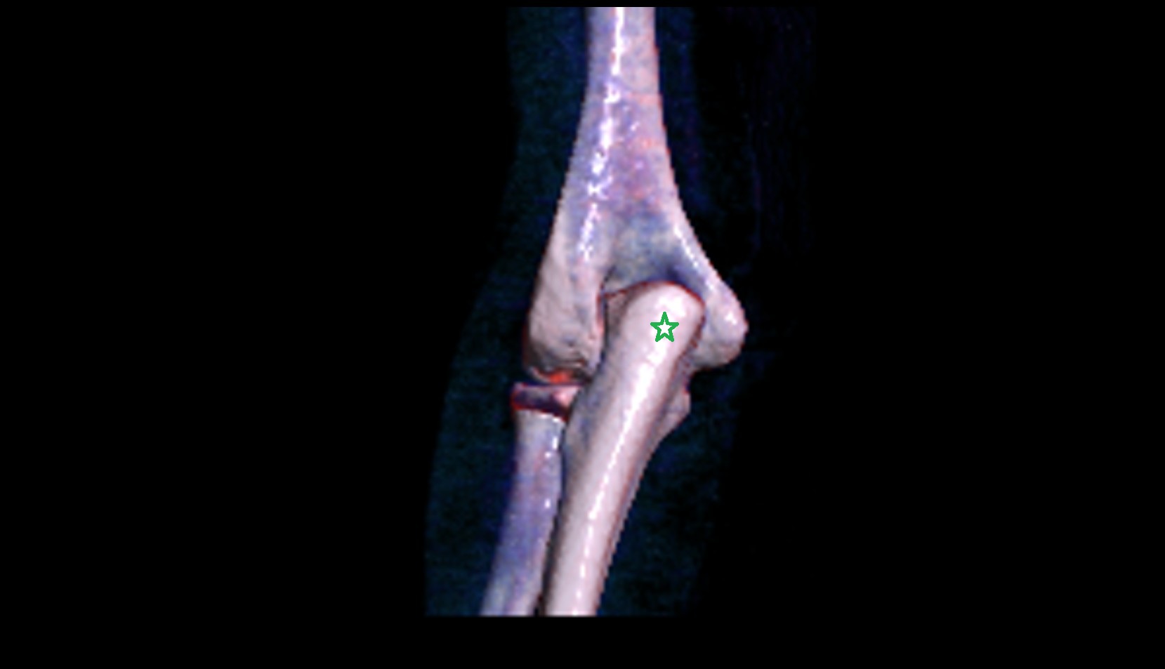olecranon process of ulna 3D VRT IMAGE
