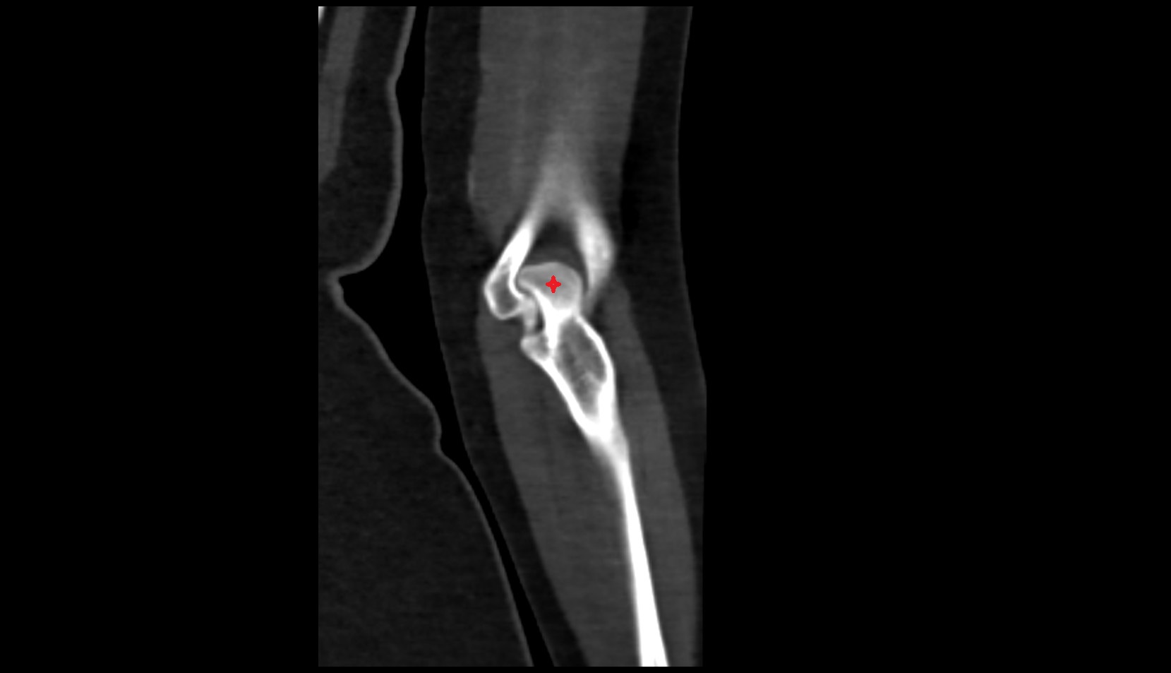 olecranon process of ulna coronal ct image