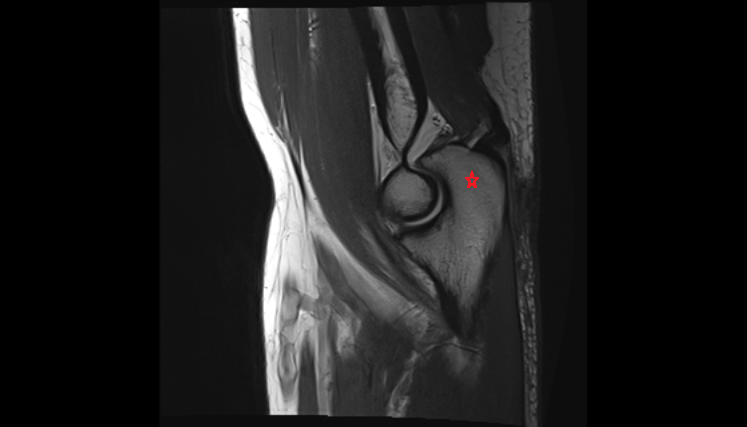 olecranon process of ulna sag cross sectional anatomy 3T MRI AI enhanced radiology image -img-00000-00000