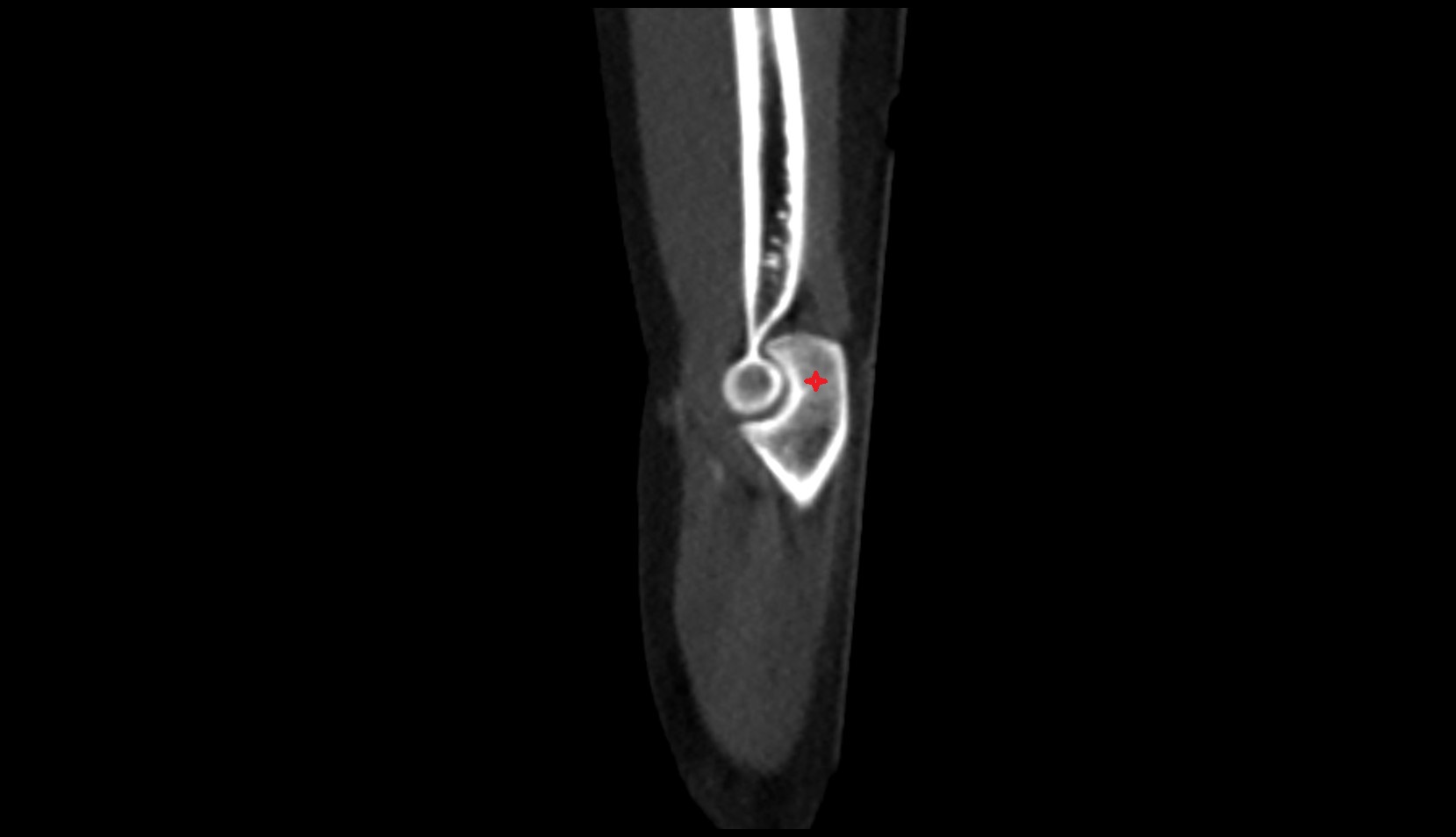 olecranon process of ulna sag ct image