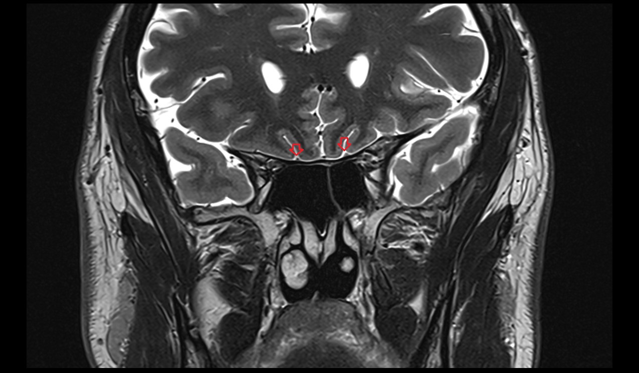 olfactory cistern mri 3t coronal image