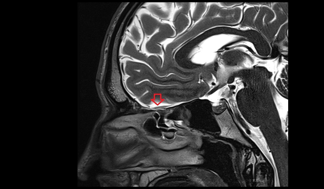 olfactory cistern mri 3t sagittal image