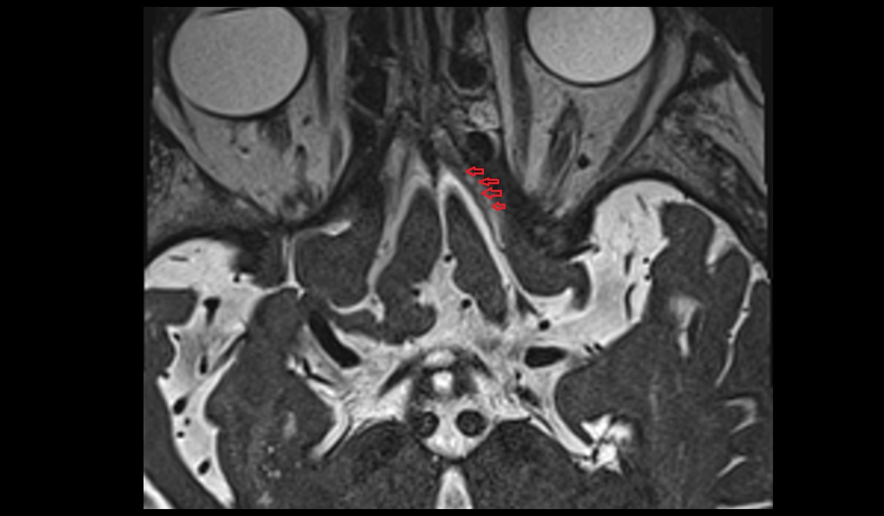 olfactory nerve (Cranial nerve I) axial 3T MRI image