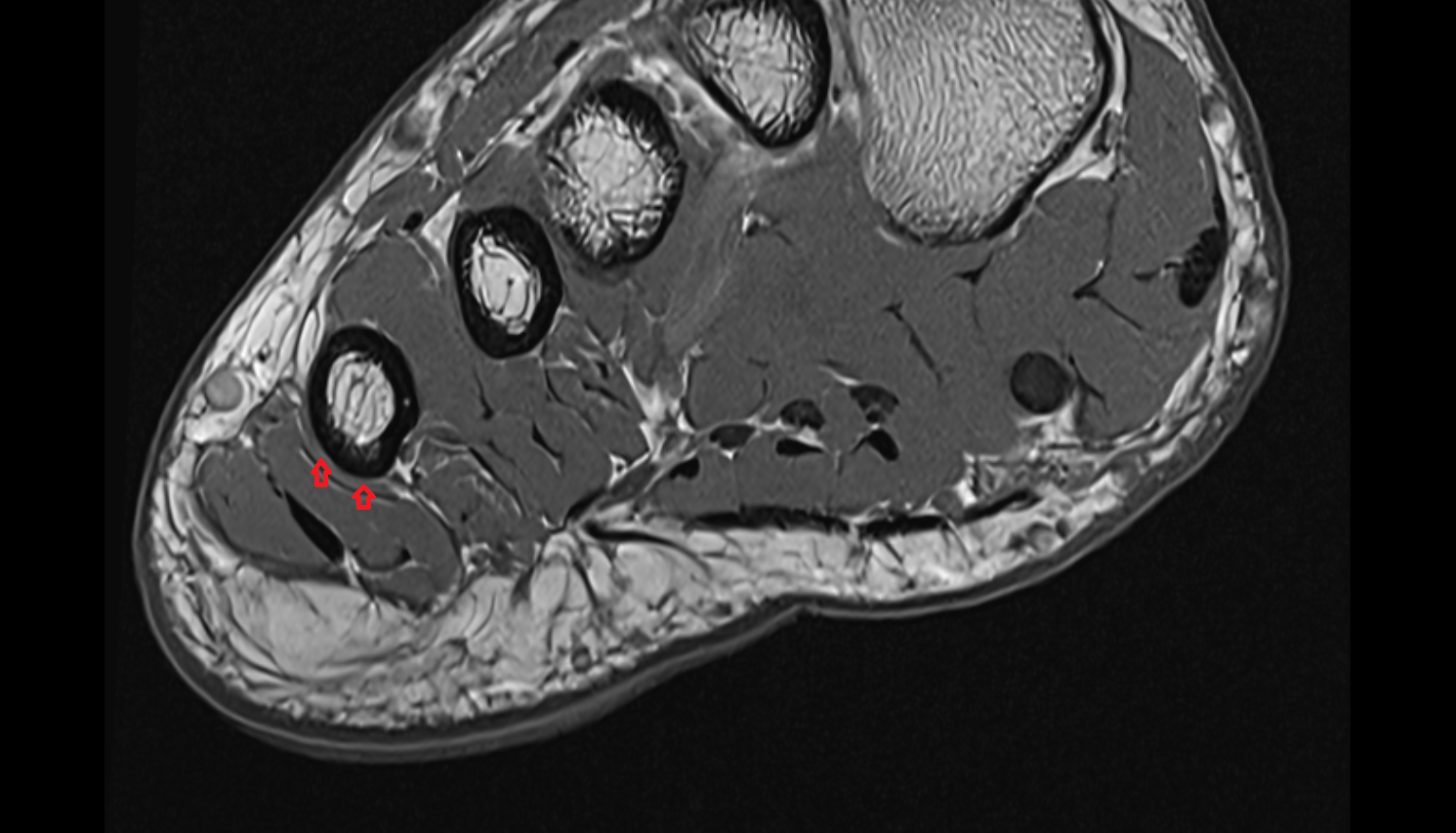 opponens digiti minimi muscle of foot  axialcross sectional anatomy 3T MRI AI enhanced radiology image-img-00000-00000