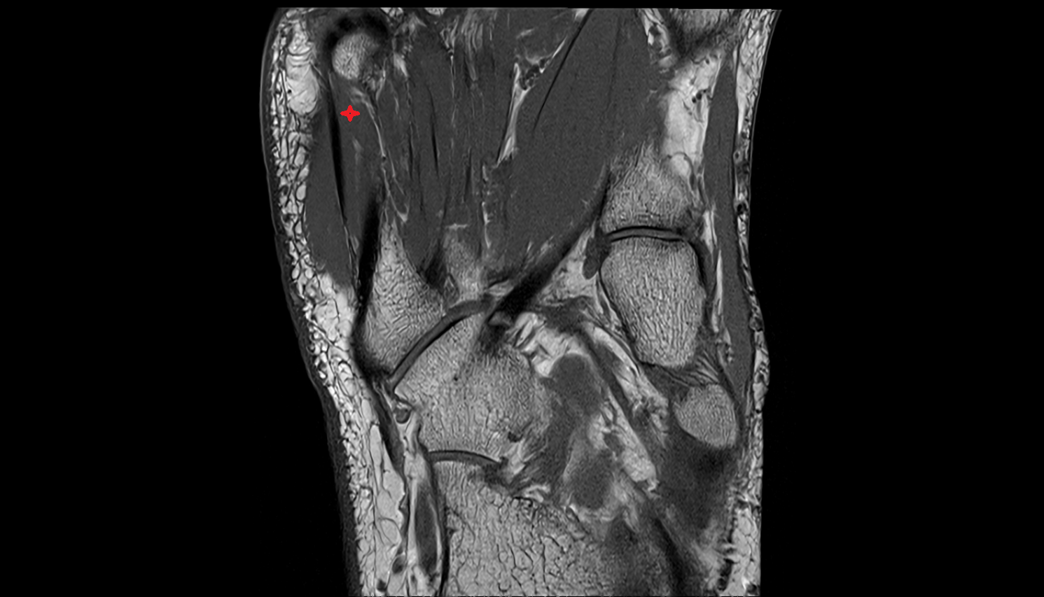 opponens digiti minimi muscle of foot coronal cross sectional anatomy 3T MRI AI enhanced radiology image-img-00000-00000_00001