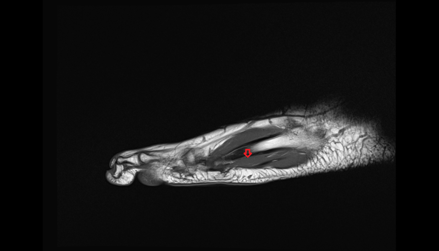 opponens digiti minimi muscle of foot sag cross sectional anatomy 3T MRI AI enhanced radiology image-img-00000-00000