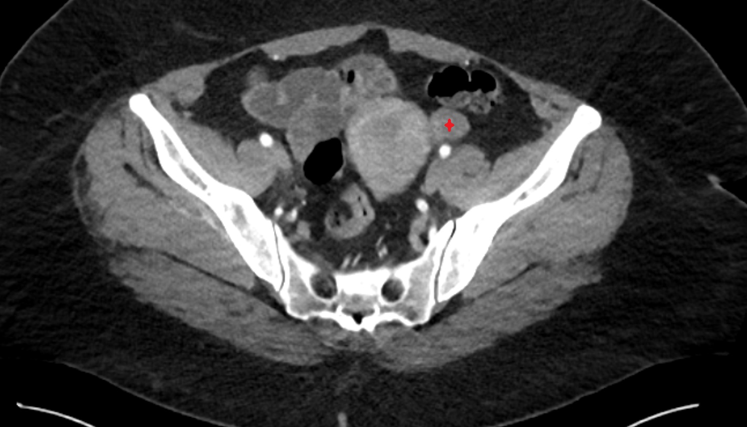 ovaries   CT  axial  image anatomy  image-img-00000-00000