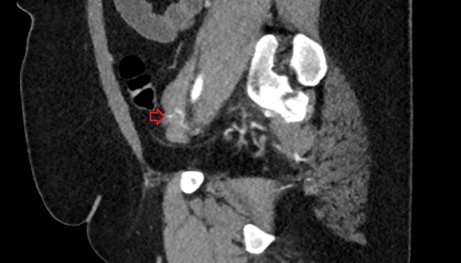 ovaries   CT  sagittal  image anatomy  image-img-00000-00000