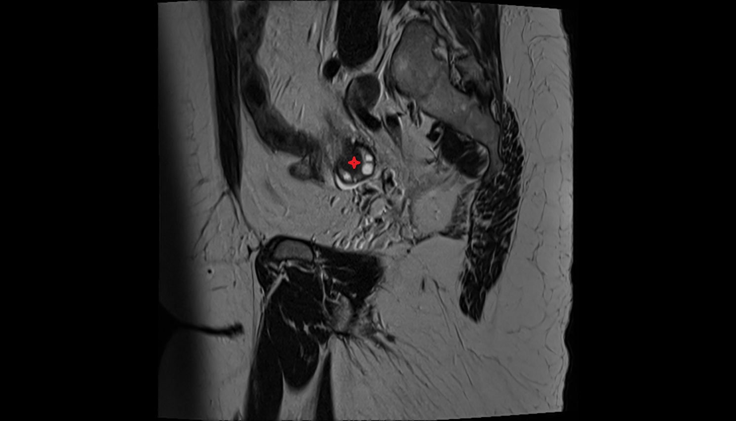 ovaries  MRI  SAG  image anatomy  image-img-00000-00000