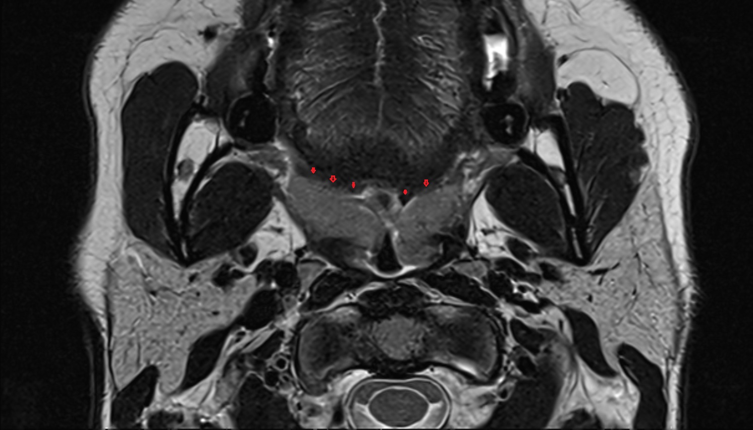 palatoglossus muscle mri axial image 1 -img-00000-00000