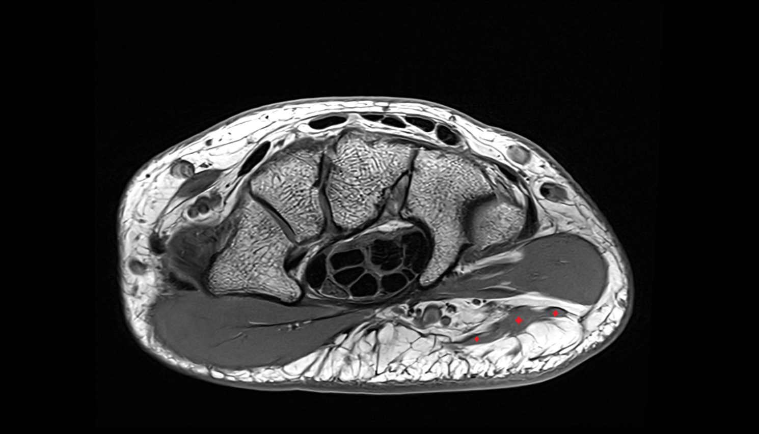 palmaris brevis muscle  axial cross sectional anatomy 3T MRI AI enhanced radiology image-img-00000-00000