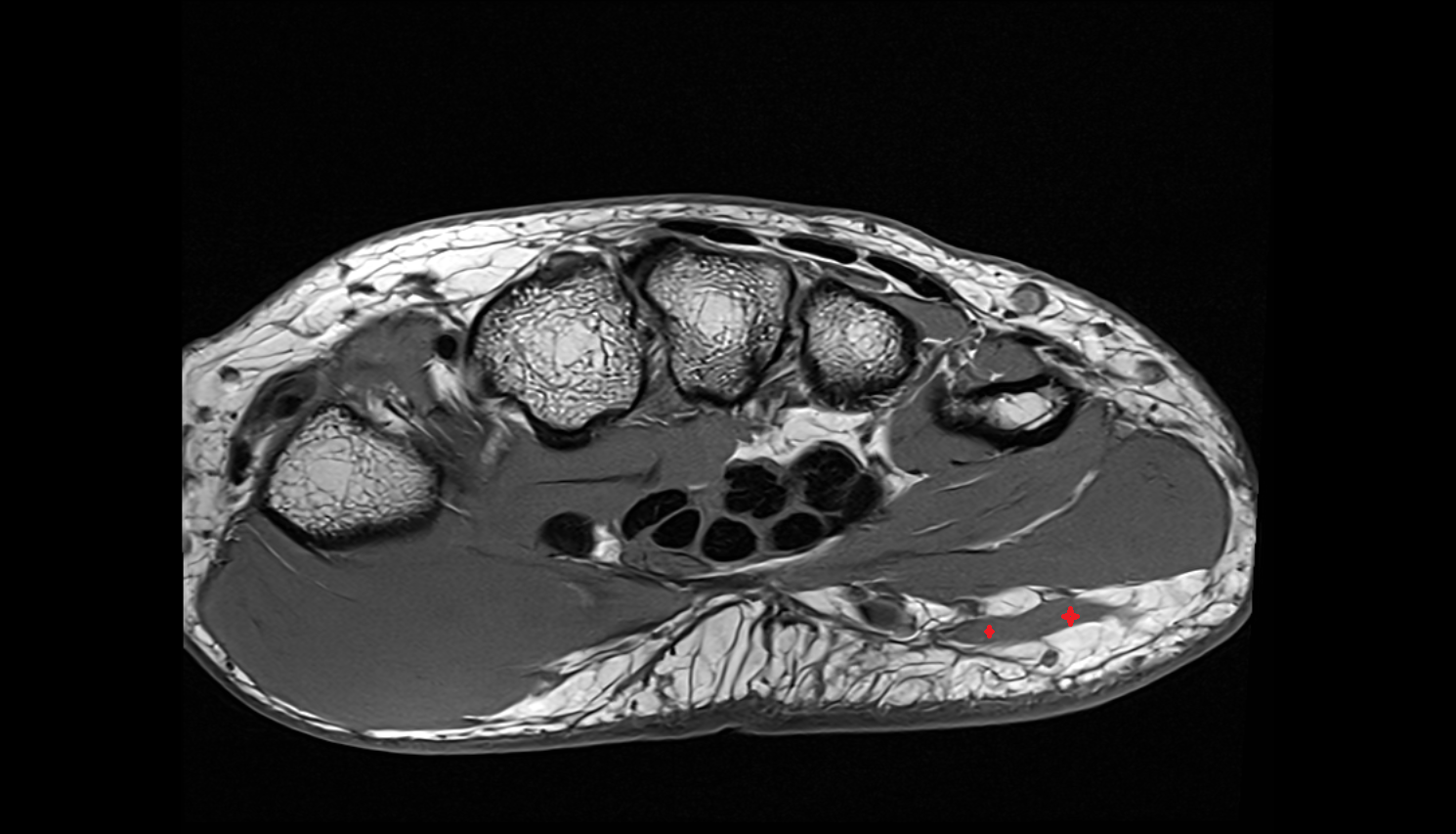 palmaris brevis muscle  axial cross sectional anatomy 3T MRI AI enhanced radiology image-img-00000-00000_00001