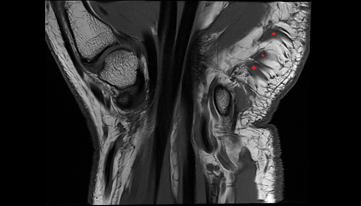 palmaris brevis muscle  coronal cross sectional anatomy 3T MRI AI enhanced radiology image-img-00000-00000