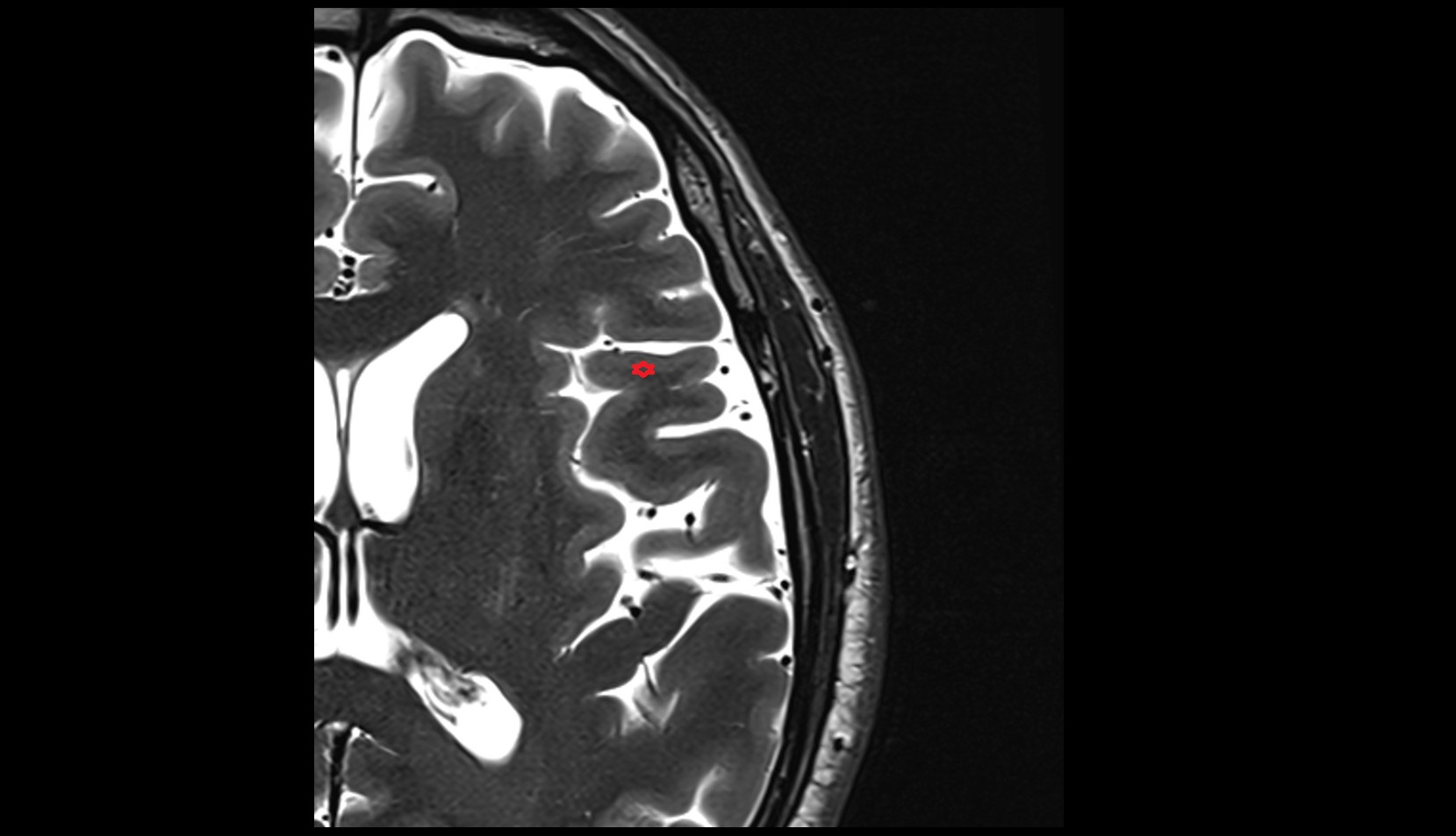 pars opercularis of inferior frontal gyrus MRI 3t axial image