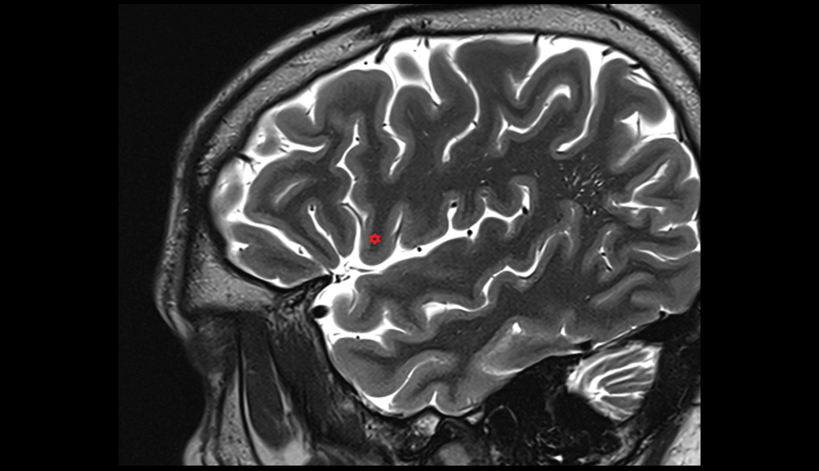 pars opercularis of inferior frontal gyrus MRI 3t sagittal image
