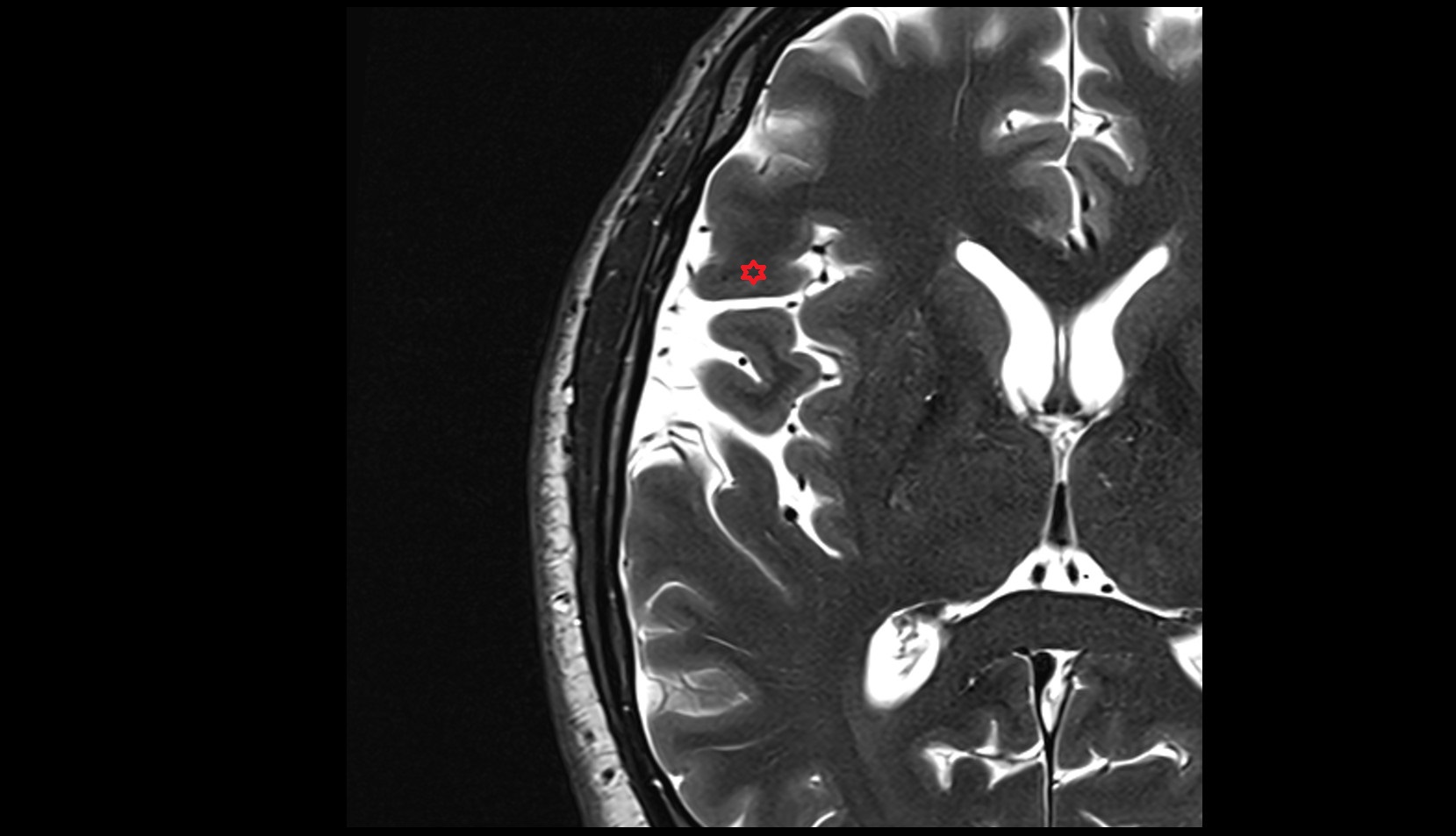 pars orbitalis of inferior  frontal gyrus MRI 3T axiall image