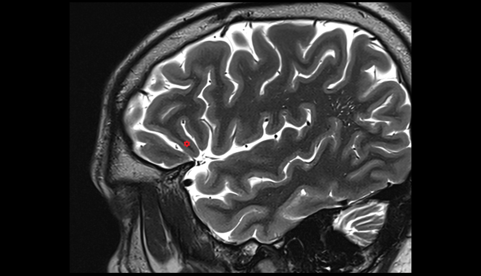 pars orbitalis of inferior  frontal gyrus MRI 3T sagittal image