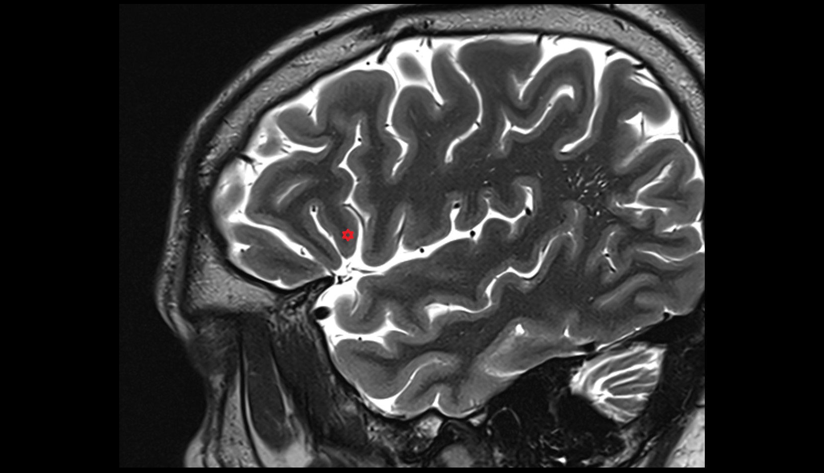 pars triangularis of inferior frontal gyrus MRI 3T SAGITAL IMAGE