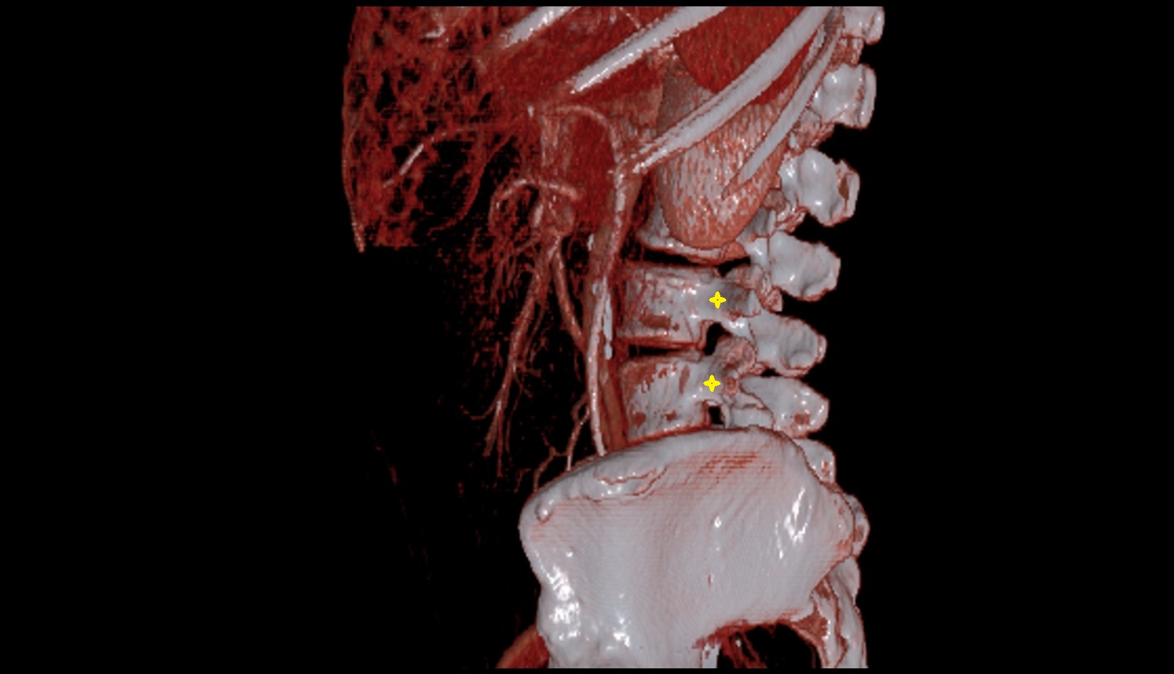 pedicle of vertebrae ct  3d image