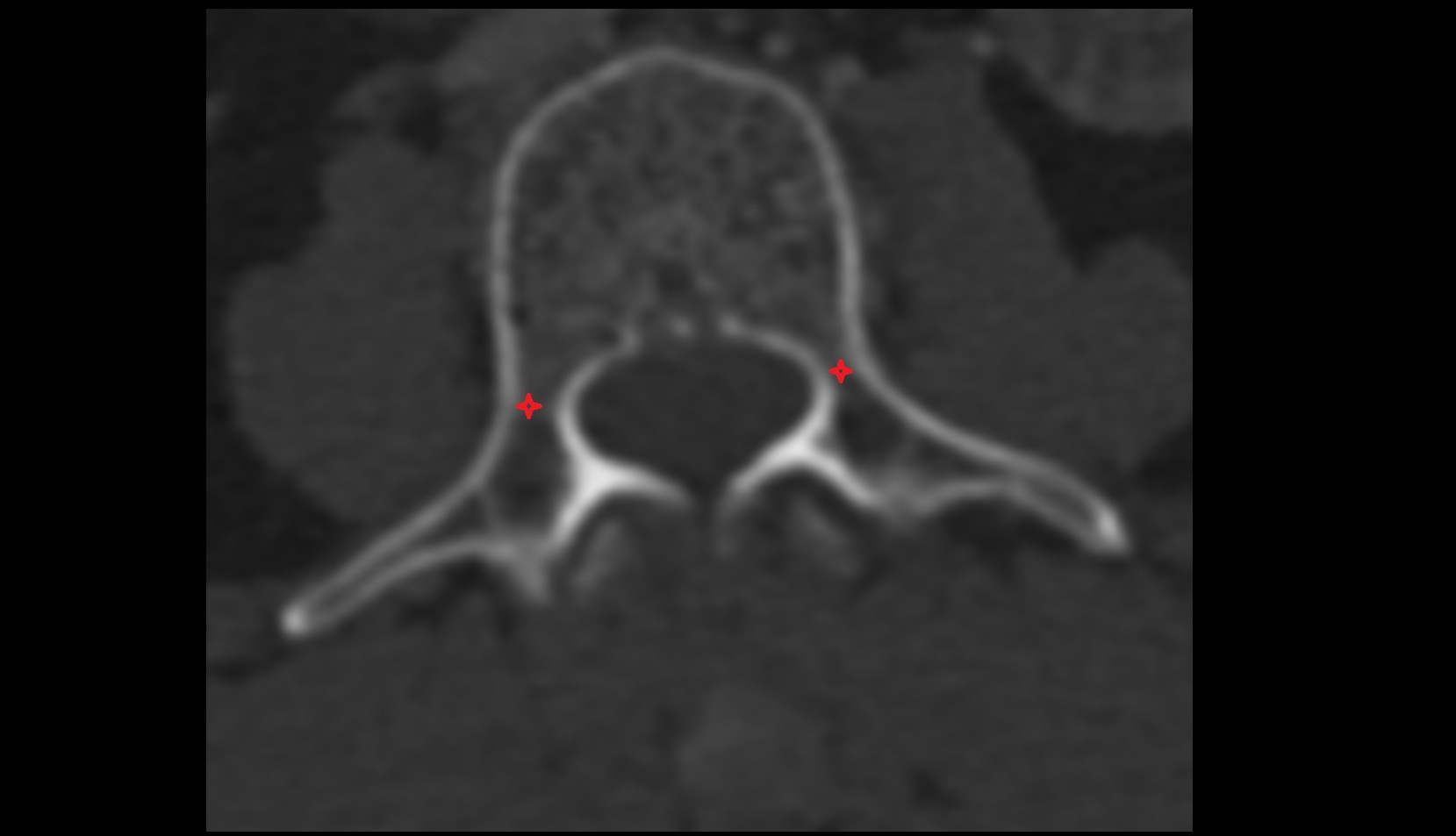 pedicle of vertebrae ct axial image