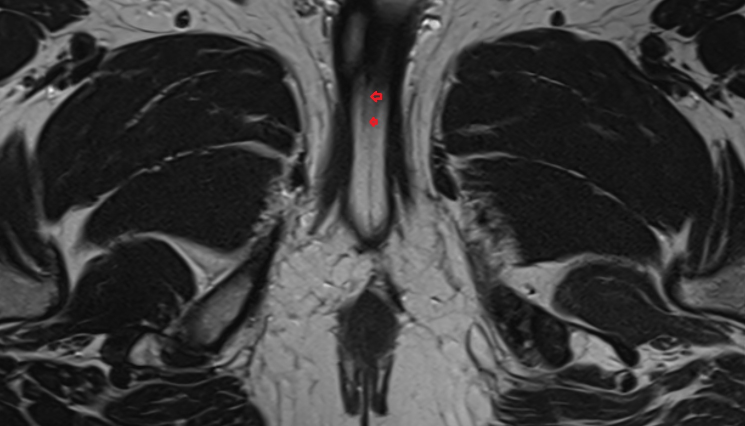 penile urethra  MRI  axial  anatomy  image-img-00000-00000