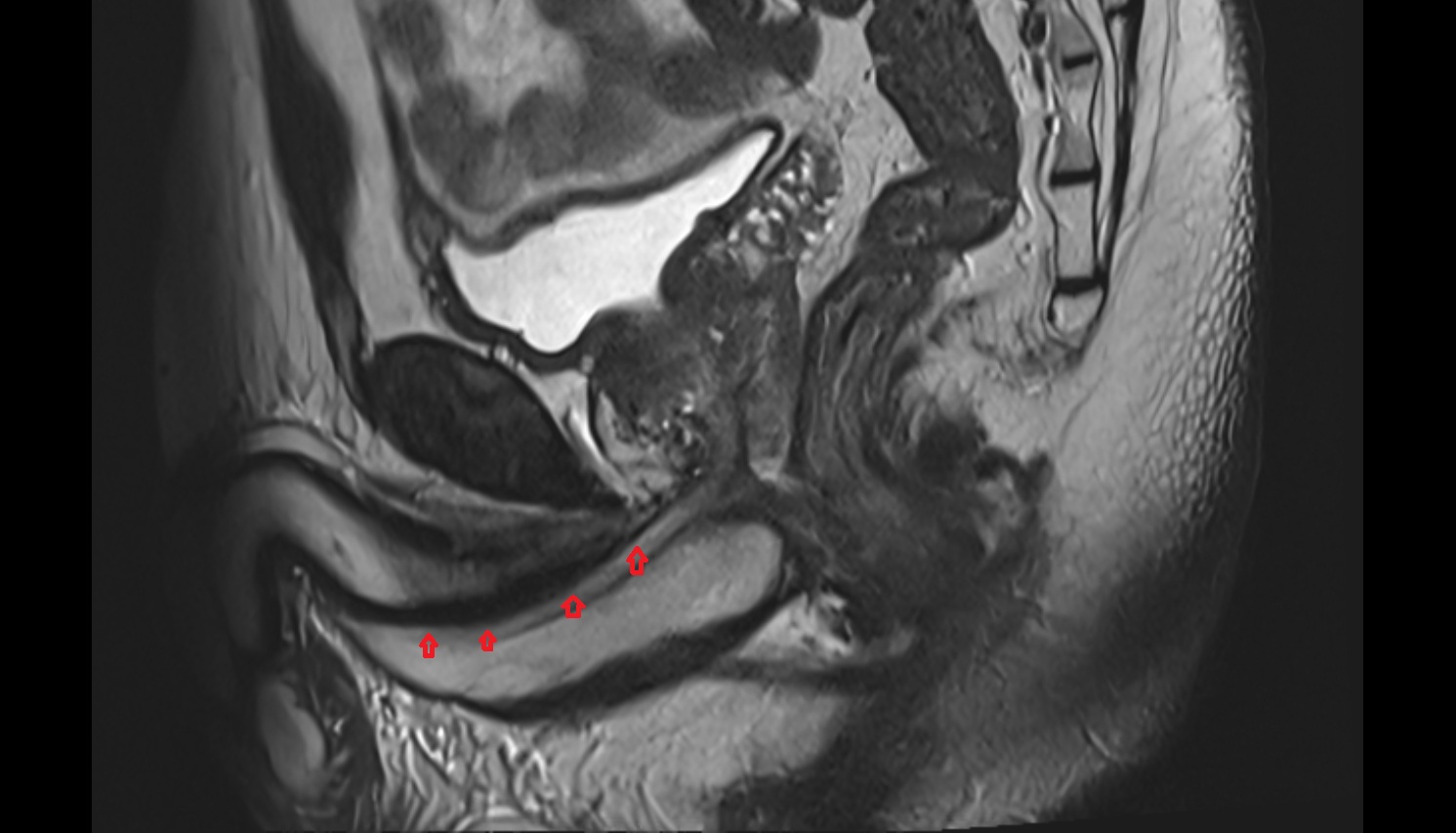 penile urethra  MRI  sagittal  anatomy  image-img-00000-00000