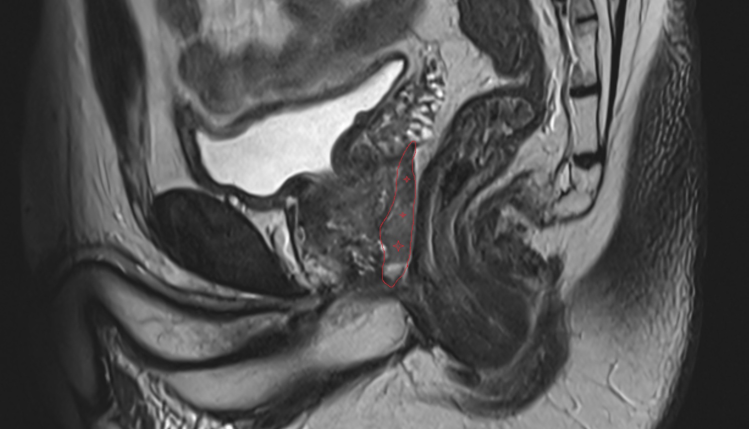 peripheral zone of prostate  MRI sagittal  anatomy  image-img-00000-00000