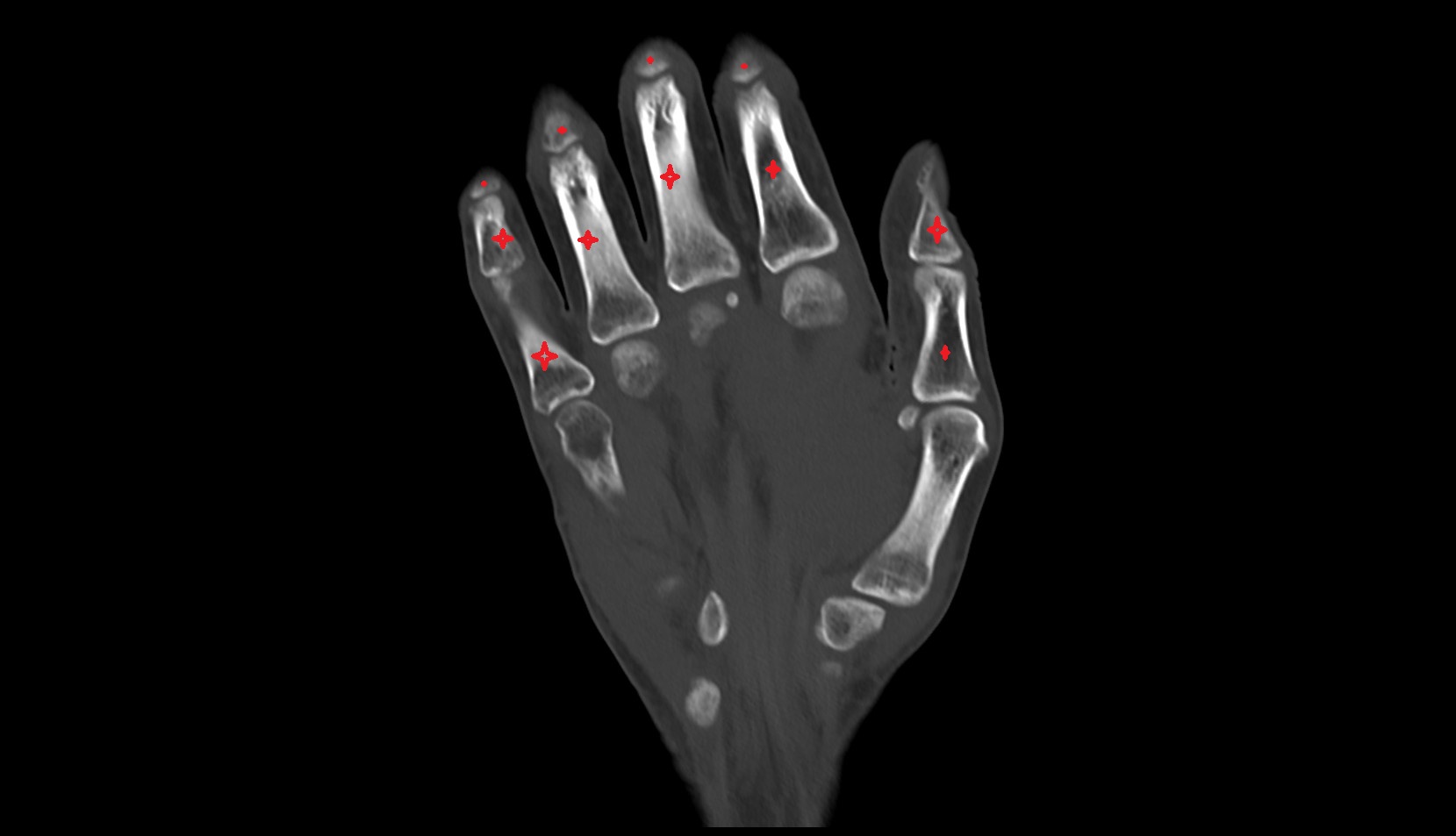 phalanx bone hand CORONAL CT IMAGE