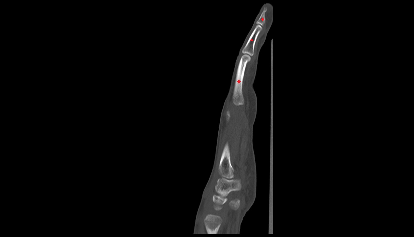 phalanx bone hand SAG CT IMAGE