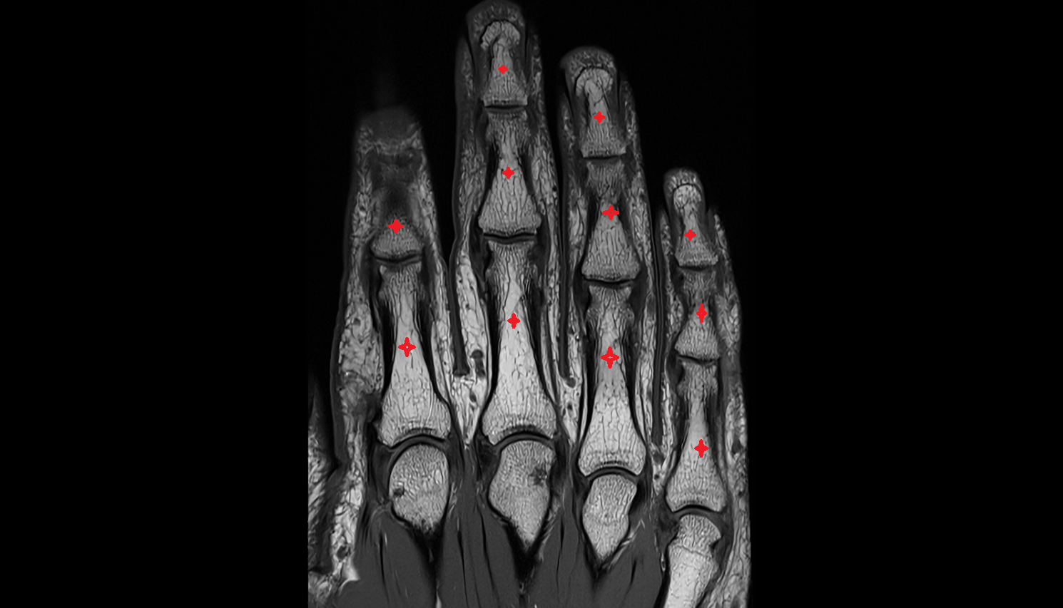 phalanx bone hand coronal cross sectional anatomy 3T MRI AI enhanced radiology image-img-00000-00000