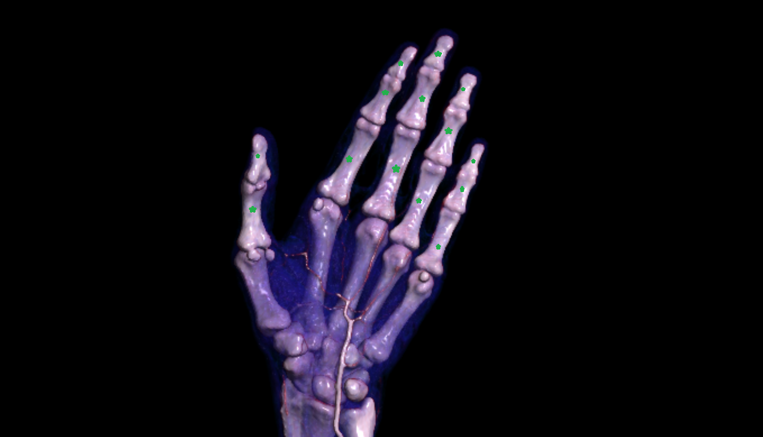 phalanx of hand 3D VRT  CT image -img-00000-00000