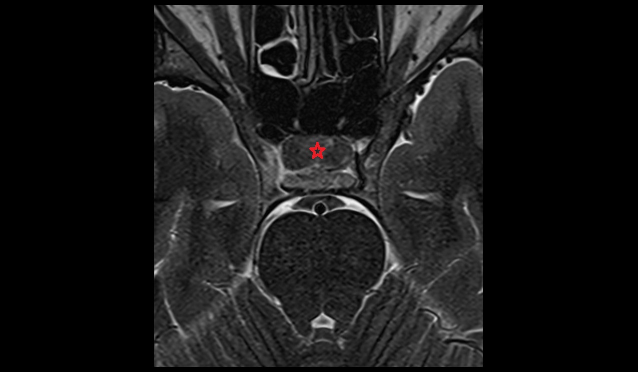 pituitary gland mri 3t axial image