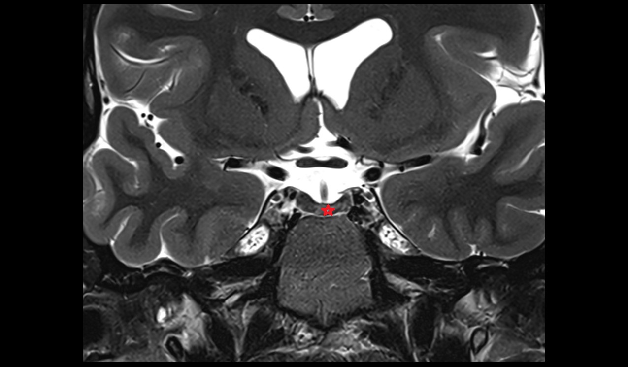 pituitary gland mri 3t coronal image