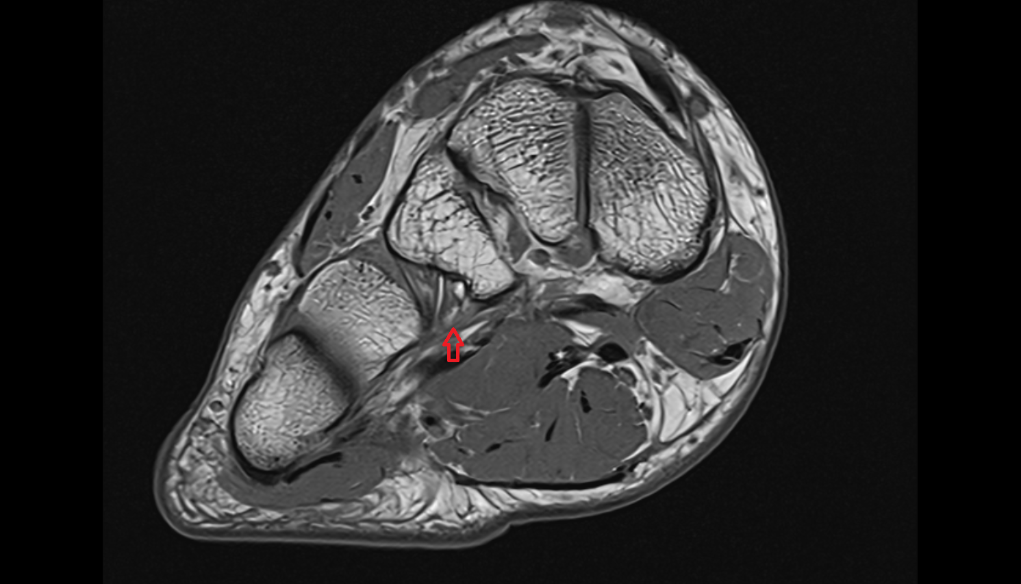 plantar cuneocuboid ligament axial  cross sectional anatomy 3T MRI AI enhanced radiology image-img-00000-00000