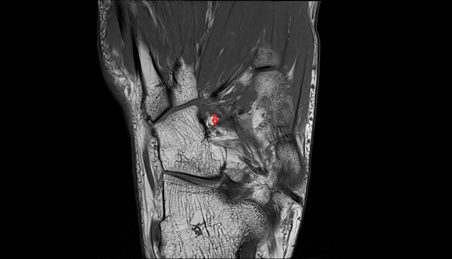 plantar cuneocuboid ligament coronal  cross sectional anatomy 3T MRI AI enhanced radiology image-img-00000-00000