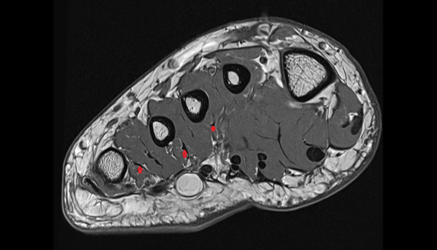 plantar interossei tendons of foot  sfov  of the Foot axial cross sectional anatomy 3T MRI AI enhanced radiology image-img-00000-00000