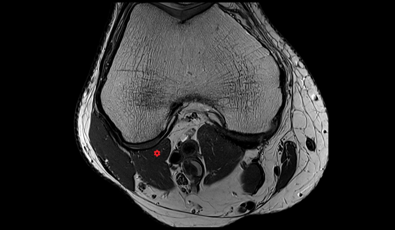 plantaris muscle anatomy MRI 3T image