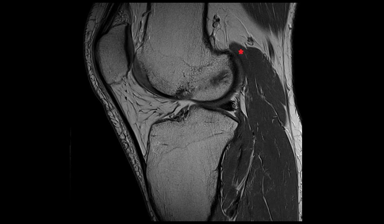 plantaris muscle anatomy image