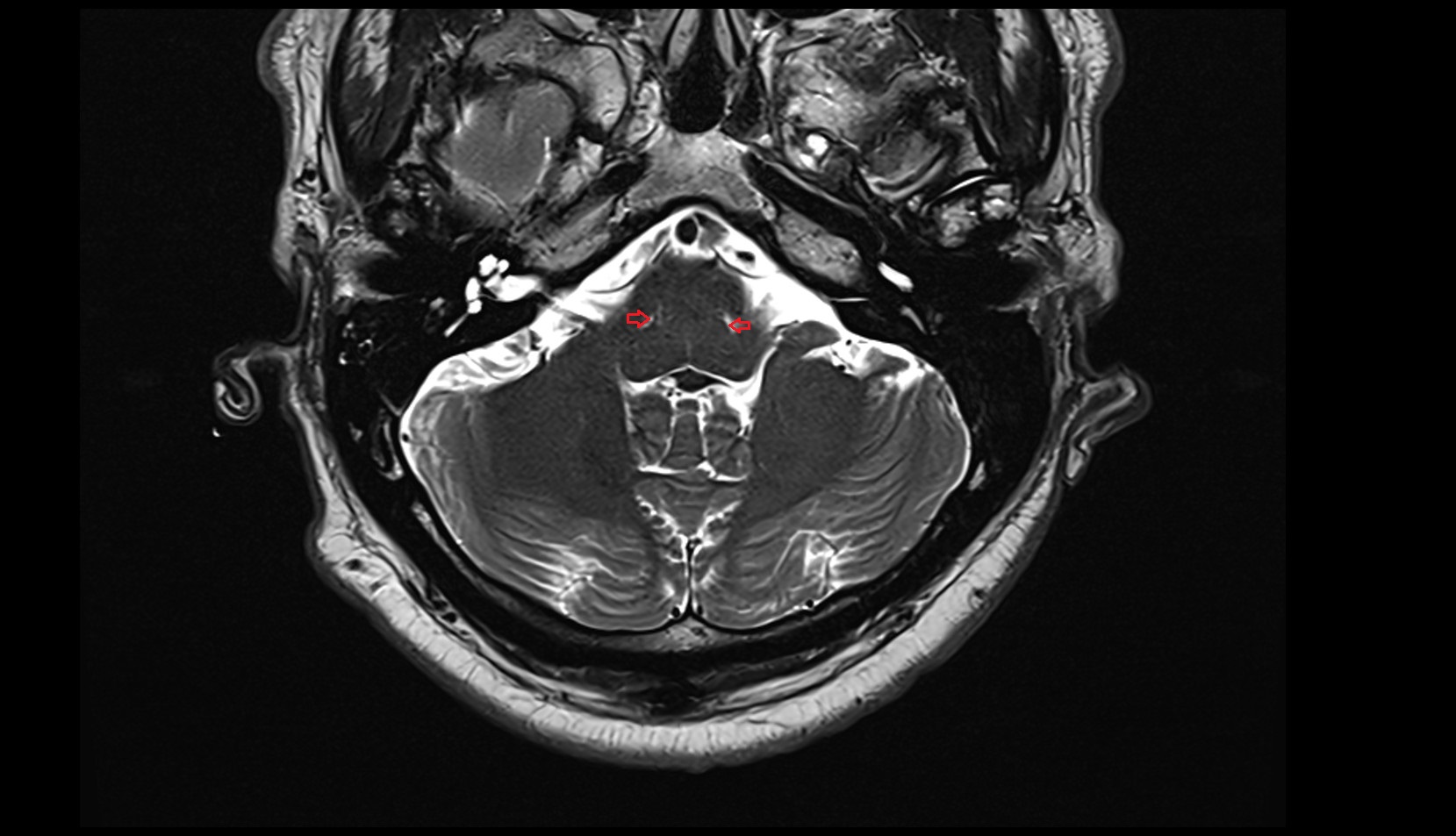pontomedullary sulcus MRI 3T axial image